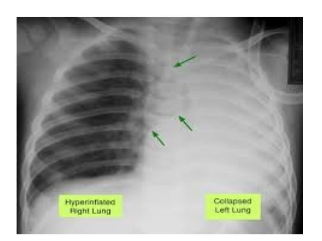 Collapse and consolidation Lung Radiology