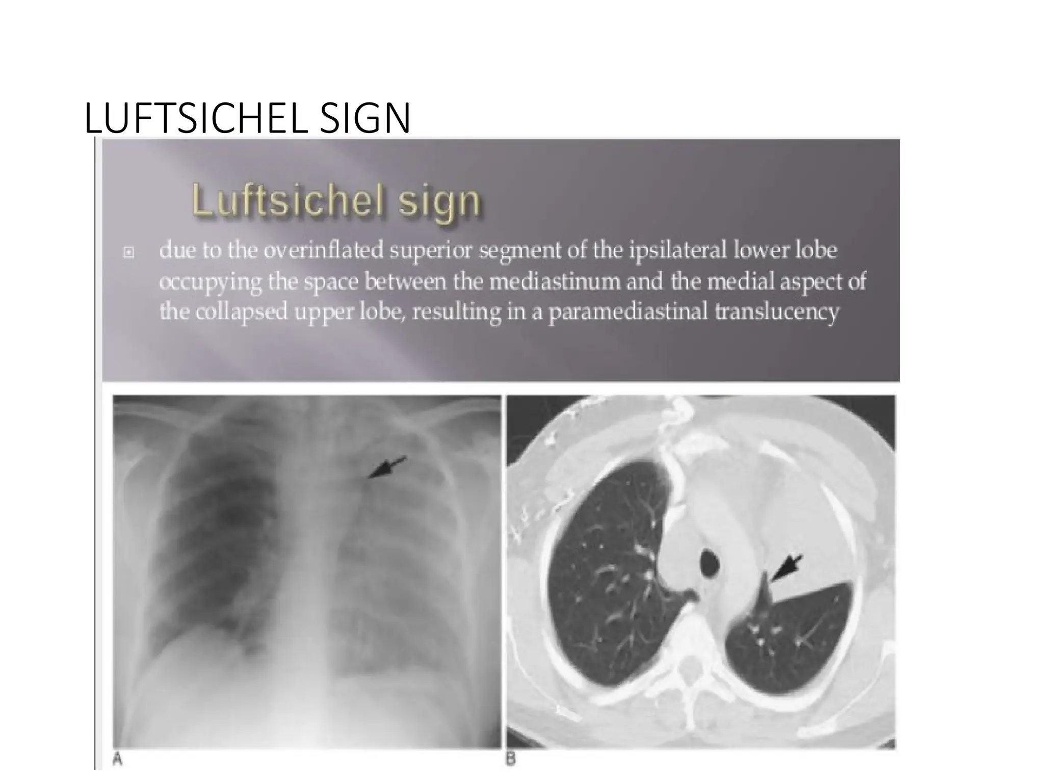 Luftcycle Sign Collapse and Consolidation Pathology and radiology | PPTX