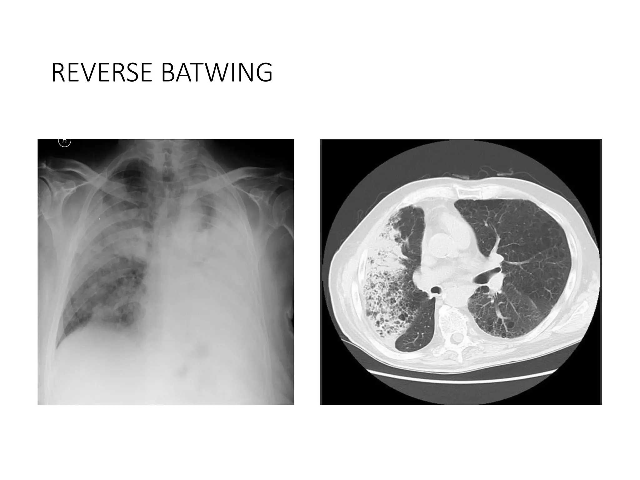 Batwing Sign Fast Collapse and Consolidation Pathology and radiology | PPTX