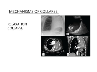 Collapse and Consolidation Pathology and radiology | PPTX