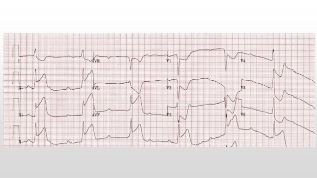 Collapse and syncope