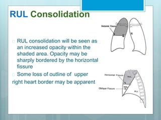 RUL Consolidation 
 RUL consolidation will be seen as 
an increased opacity within the 
shaded area. Opacity may be 
sharply bordered by the horizontal 
fissure 
 Some loss of outline of upper 
right heart border may be apparent 
 