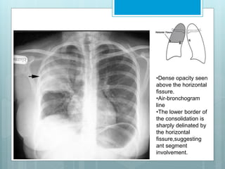 •Dense opacity seen 
above the horizontal 
fissure. 
•Air-bronchogram 
line 
•The lower border of 
the consolidation is 
sharply delinated by 
the horizontal 
fissure,suggesting 
ant segment 
involvement. 
 