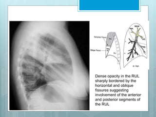 Dense opacity in the RUL 
sharply bordered by the 
horizontal and oblique 
fissures suggesting 
involvement of the anterior 
and posterior segments of 
the RUL 
 
