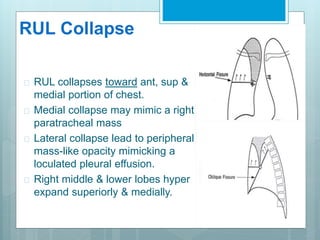 RUL Collapse 
 RUL collapses toward ant, sup & 
medial portion of chest. 
 Medial collapse may mimic a right 
paratracheal mass 
 Lateral collapse lead to peripheral 
mass-like opacity mimicking a 
loculated pleural effusion. 
 Right middle & lower lobes hyper 
expand superiorly & medially. 
 