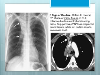 S Sign of Golden - Refers to reverse 
"S" shape of minor fissure in RUL 
collapse due to a central obstructing 
mass. Sup portion of "S" form displaced 
minor fissure, while inf. portion results 
from mass itself. 
 