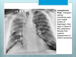Juxtaphrenic 
Peak - triangular 
opacity 
sometimes seen 
over medial 
portion of 
diaphragm. Also 
seen in cases of 
RUL lobectomy. 
Results from 
superior 
displacement of 
inferior accessory 
 