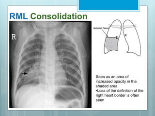 RML Consolidation 
Seen as an area of 
increased opacity in the 
shaded area 
•Loss of the definition of the 
right heart border is often 
seen 
 