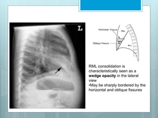RML consolidation is 
characteristically seen as a 
wedge opacity in the lateral 
view 
•May be sharply bordered by the 
horizontal and oblique fissures 
 