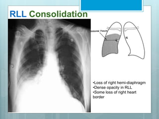 RLL Consolidation 
•Loss of right hemi-diaphragm 
•Dense opacity in RLL 
•Some loss of right heart 
border 
 