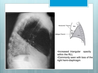 •Increased triangular opacity 
within the RLL 
•Commonly seen with loss of the 
right hemi-diaphragm 
 