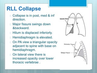 RLL Collapse 
 Collapse is in post, med & inf 
direction. 
 Major fissure swings down 
&backward. 
 Hilum is displaced inferiorly. 
 Hemidiaphragm is elevated. 
 On PA view a triangular opacity 
adjacent to spine with base on 
hemidiaphragm. 
 On lateral view there is 
increased opacity over lower 
thoracic vertebrae . 
 