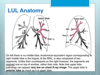 LUL Anatomy 
On left there is no middle lobe; Anatomical equivalent region corresponding to 
right middle lobe is the lingula, & like RML, is also composed of two 
segments. Unlike their counterparts on the right however, the segments are 
stacked one on top of another, rather than side. Note that upper lobe 
pathology can appear very low on chest X-ray image. The upper lobe is 
anterior lobe as much as it is upper lobe. 
 