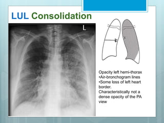 LUL Consolidation 
Opacity left hemi-thorax 
•Air-bronchogram lines 
•Some loss of left heart 
border. 
Characteristically not a 
dense opacity of the PA 
view 
 