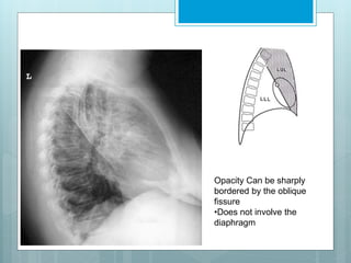 Opacity Can be sharply 
bordered by the oblique 
fissure 
•Does not involve the 
diaphragm 
 