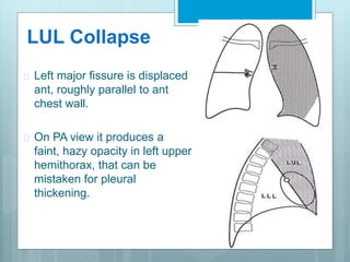 LUL Collapse 
 Left major fissure is displaced 
ant, roughly parallel to ant 
chest wall. 
 On PA view it produces a 
faint, hazy opacity in left upper 
hemithorax, that can be 
mistaken for pleural 
thickening. 
 