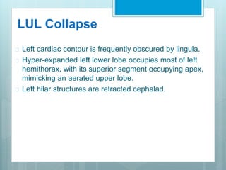 LUL Collapse 
 Left cardiac contour is frequently obscured by lingula. 
 Hyper-expanded left lower lobe occupies most of left 
hemithorax, with its superior segment occupying apex, 
mimicking an aerated upper lobe. 
 Left hilar structures are retracted cephalad. 
 