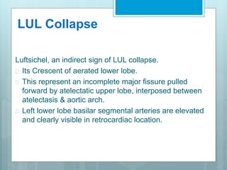 LUL Collapse 
Luftsichel, an indirect sign of LUL collapse. 
 Its Crescent of aerated lower lobe. 
 This represent an incomplete major fissure pulled 
forward by atelectatic upper lobe, interposed between 
atelectasis & aortic arch. 
 Left lower lobe basilar segmental arteries are elevated 
and clearly visible in retrocardiac location. 
 