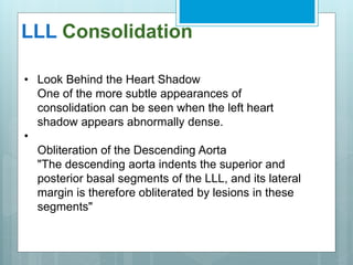 LLL Consolidation 
• Look Behind the Heart Shadow 
One of the more subtle appearances of 
consolidation can be seen when the left heart 
shadow appears abnormally dense. 
• 
Obliteration of the Descending Aorta 
"The descending aorta indents the superior and 
posterior basal segments of the LLL, and its lateral 
margin is therefore obliterated by lesions in these 
segments" 
 