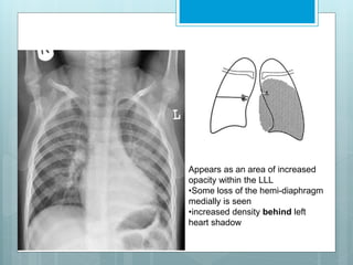 Appears as an area of increased 
opacity within the LLL 
•Some loss of the hemi-diaphragm 
medially is seen 
•increased density behind left 
heart shadow 
 