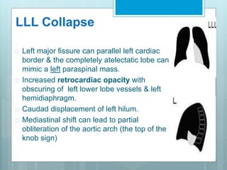 LLL Collapse 
 Left major fissure can parallel left cardiac 
border & the completely atelectatic lobe can 
mimic a left paraspinal mass. 
 Increased retrocardiac opacity with 
obscuring of left lower lobe vessels & left 
hemidiaphragm. 
 Caudad displacement of left hilum. 
 Mediastinal shift can lead to partial 
obliteration of the aortic arch (the top of the 
knob sign) 
 