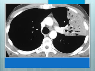 This image shows complete opacification of most of left upper lobe. When bronchi 
remain aerated, they are seen as branching lucencies called air-bronchograms. This 
image represents infectious pneumonia, limited by major fissure, resulting in a sharp 
border. 
 