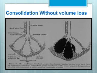 Consolidation Without volume loss 
 