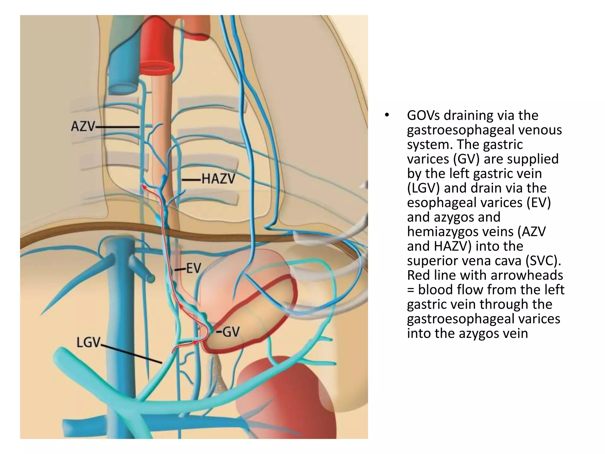 • GOVs draining via the
gastroesophageal venous
system. The gastric
varices (GV) are supplied
by the left gastric vein
(LGV) and drain via the
esophageal varices (EV)
and azygos and
hemiazygos veins (AZV
and HAZV) into the
superior vena cava (SVC).
Red line with arrowheads
= blood flow from the left
gastric vein through the
gastroesophageal varices
into the azygos vein
 
