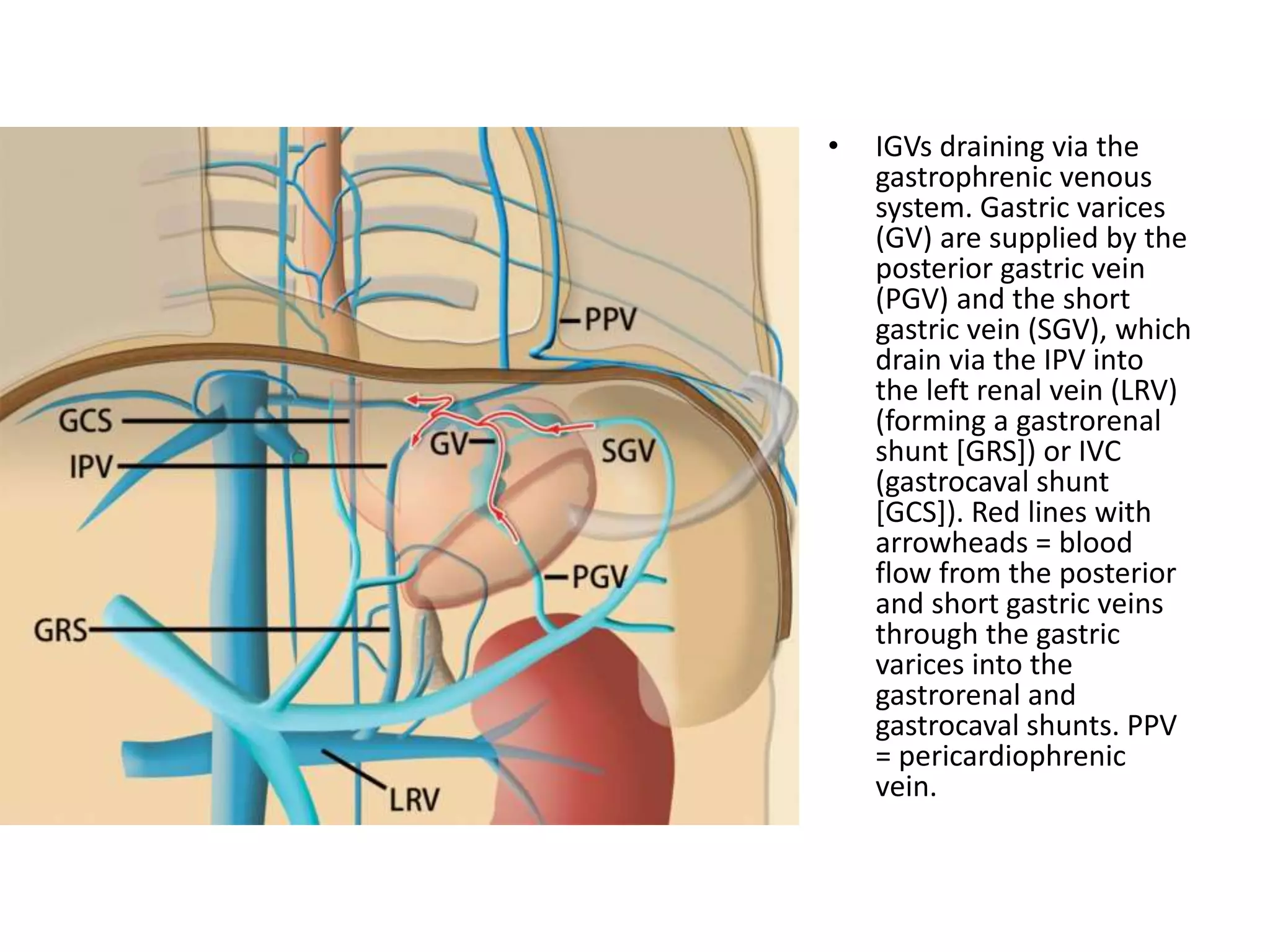 • IGVs draining via the
gastrophrenic venous
system. Gastric varices
(GV) are supplied by the
posterior gastric vein
(PGV) and the short
gastric vein (SGV), which
drain via the IPV into
the left renal vein (LRV)
(forming a gastrorenal
shunt [GRS]) or IVC
(gastrocaval shunt
[GCS]). Red lines with
arrowheads = blood
flow from the posterior
and short gastric veins
through the gastric
varices into the
gastrorenal and
gastrocaval shunts. PPV
= pericardiophrenic
vein.
 