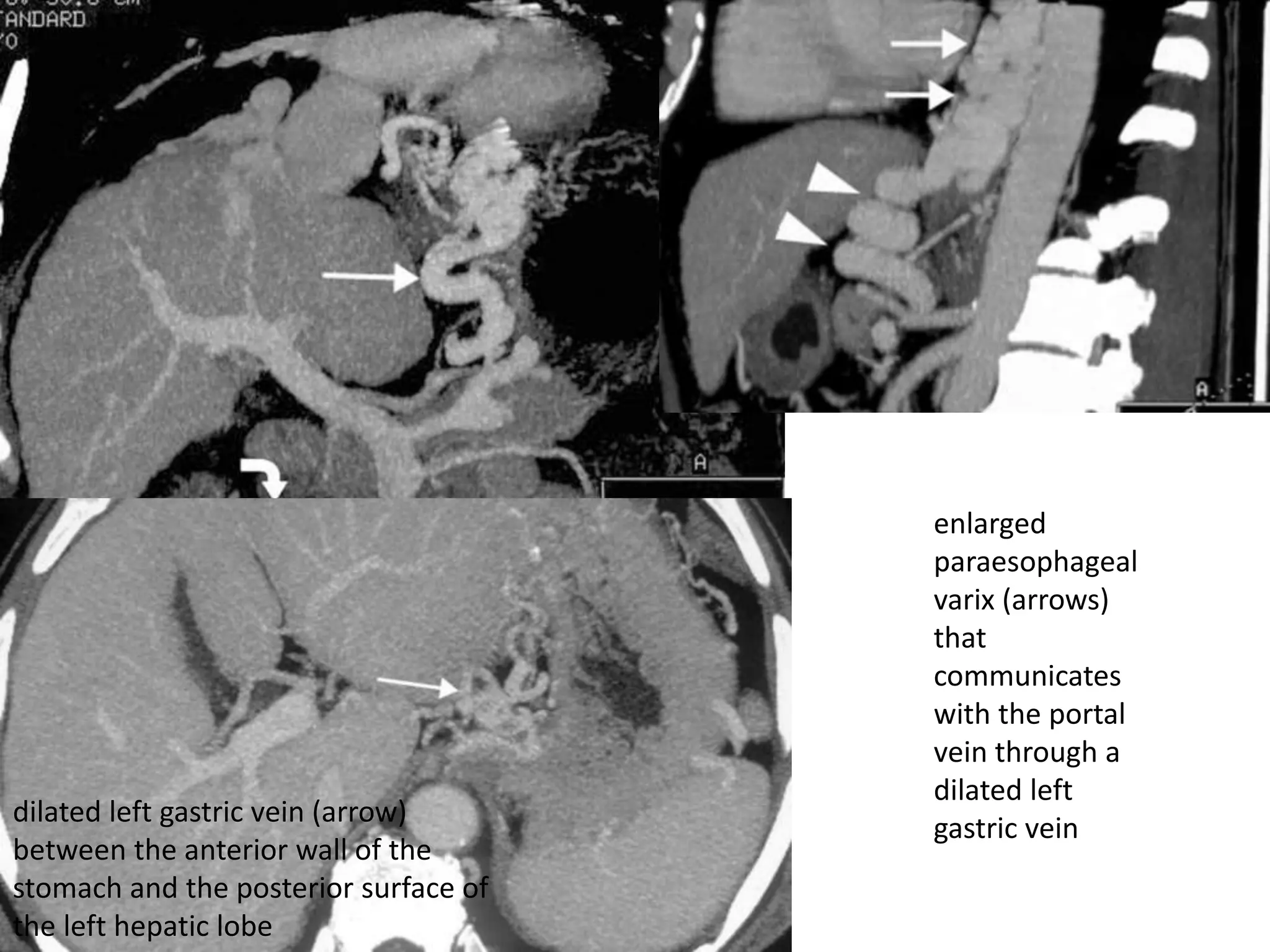 enlarged
paraesophageal
varix (arrows)
that
communicates
with the portal
vein through a
dilated left
gastric vein
dilated left gastric vein (arrow)
between the anterior wall of the
stomach and the posterior surface of
the left hepatic lobe
 