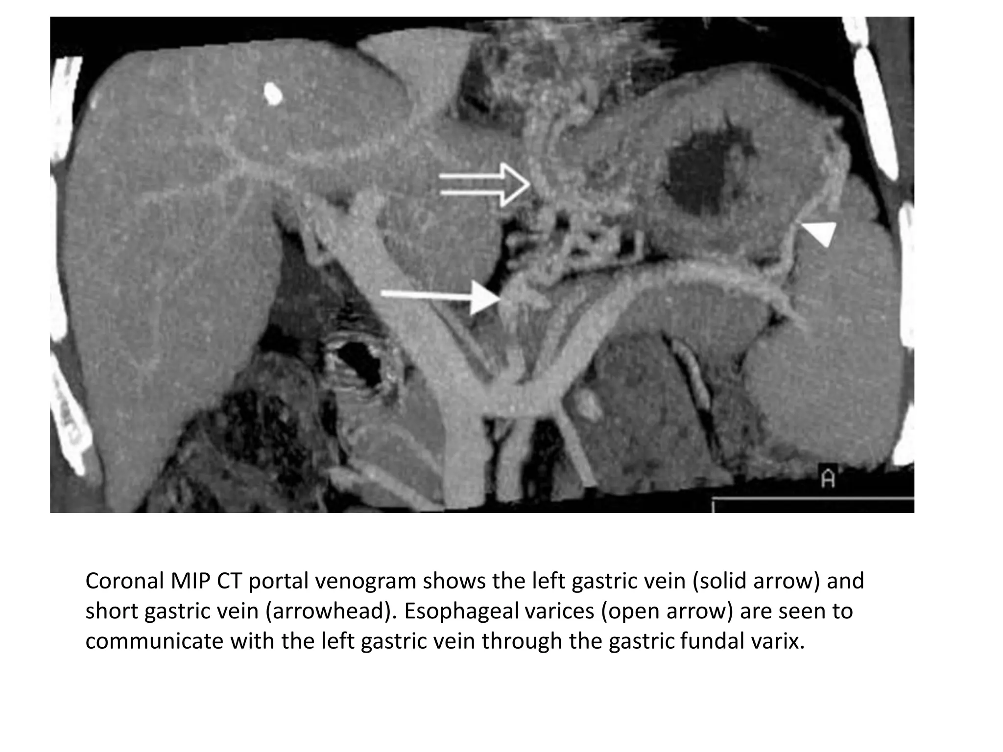 Coronal MIP CT portal venogram shows the left gastric vein (solid arrow) and
short gastric vein (arrowhead). Esophageal varices (open arrow) are seen to
communicate with the left gastric vein through the gastric fundal varix.
 