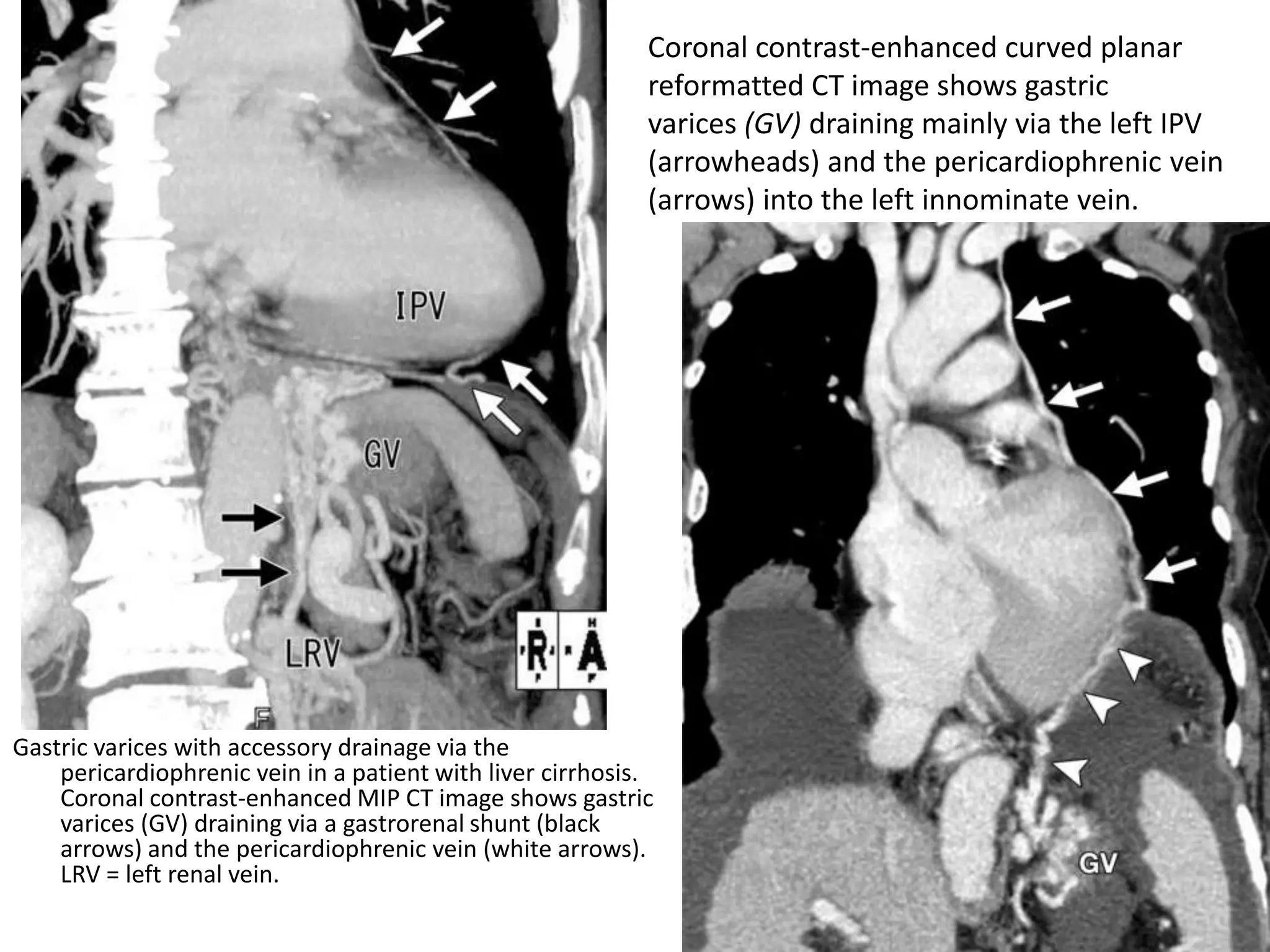 Gastric varices with accessory drainage via the
pericardiophrenic vein in a patient with liver cirrhosis.
Coronal contrast-enhanced MIP CT image shows gastric
varices (GV) draining via a gastrorenal shunt (black
arrows) and the pericardiophrenic vein (white arrows).
LRV = left renal vein.
Coronal contrast-enhanced curved planar
reformatted CT image shows gastric
varices (GV) draining mainly via the left IPV
(arrowheads) and the pericardiophrenic vein
(arrows) into the left innominate vein.
 