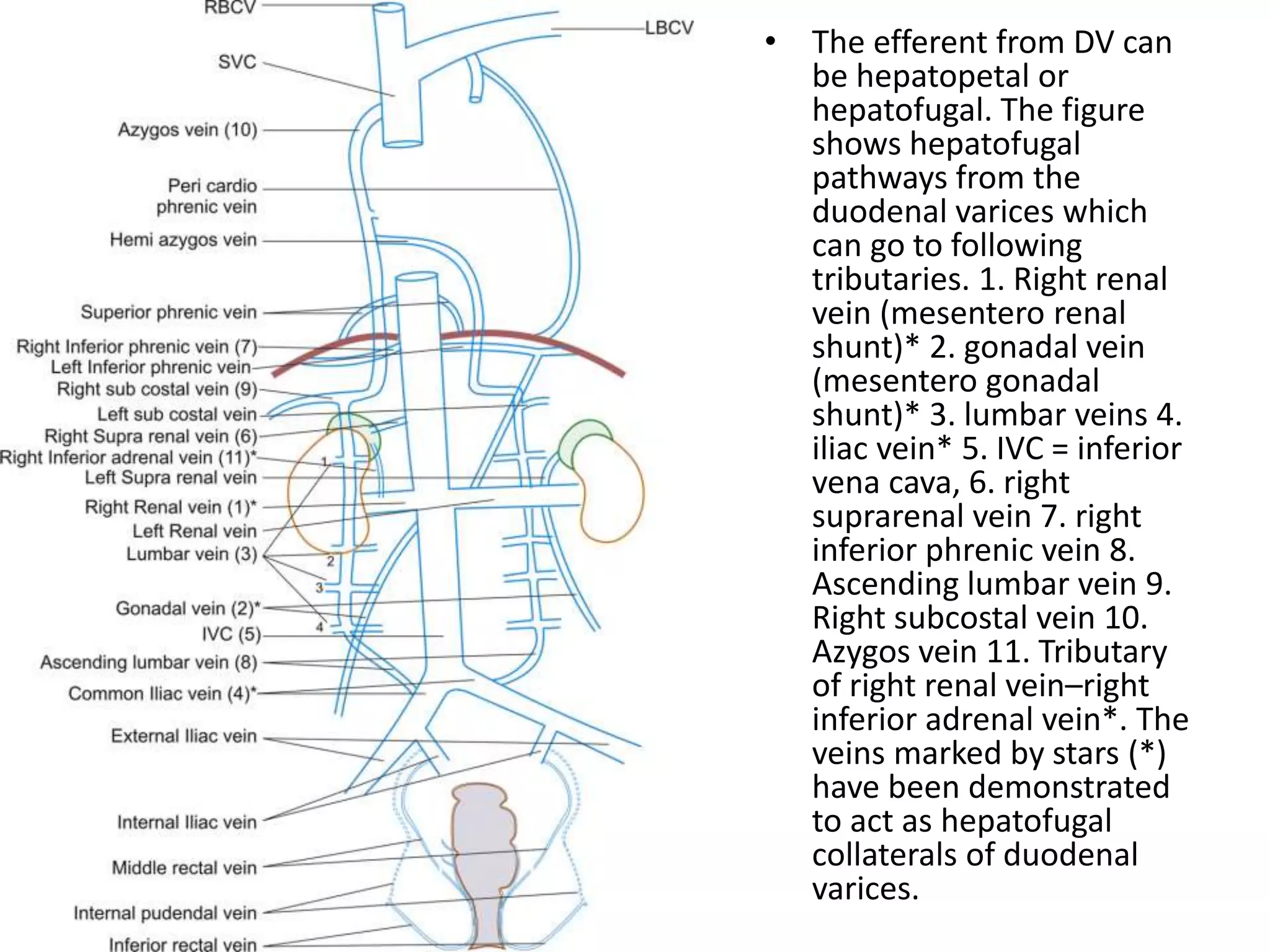 • The efferent from DV can
be hepatopetal or
hepatofugal. The figure
shows hepatofugal
pathways from the
duodenal varices which
can go to following
tributaries. 1. Right renal
vein (mesentero renal
shunt)* 2. gonadal vein
(mesentero gonadal
shunt)* 3. lumbar veins 4.
iliac vein* 5. IVC = inferior
vena cava, 6. right
suprarenal vein 7. right
inferior phrenic vein 8.
Ascending lumbar vein 9.
Right subcostal vein 10.
Azygos vein 11. Tributary
of right renal vein–right
inferior adrenal vein*. The
veins marked by stars (*)
have been demonstrated
to act as hepatofugal
collaterals of duodenal
varices.
 