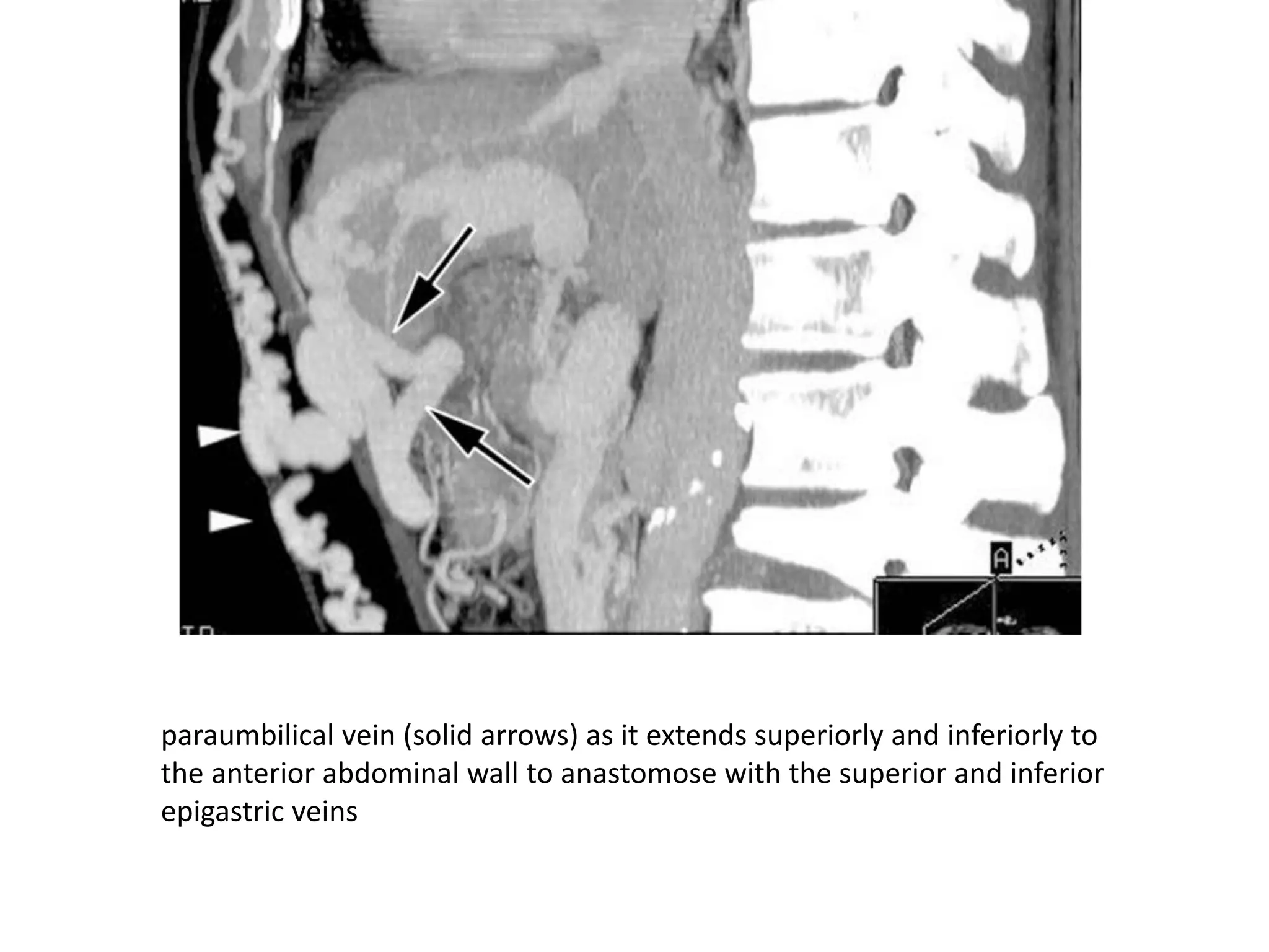 paraumbilical vein (solid arrows) as it extends superiorly and inferiorly to
the anterior abdominal wall to anastomose with the superior and inferior
epigastric veins
 