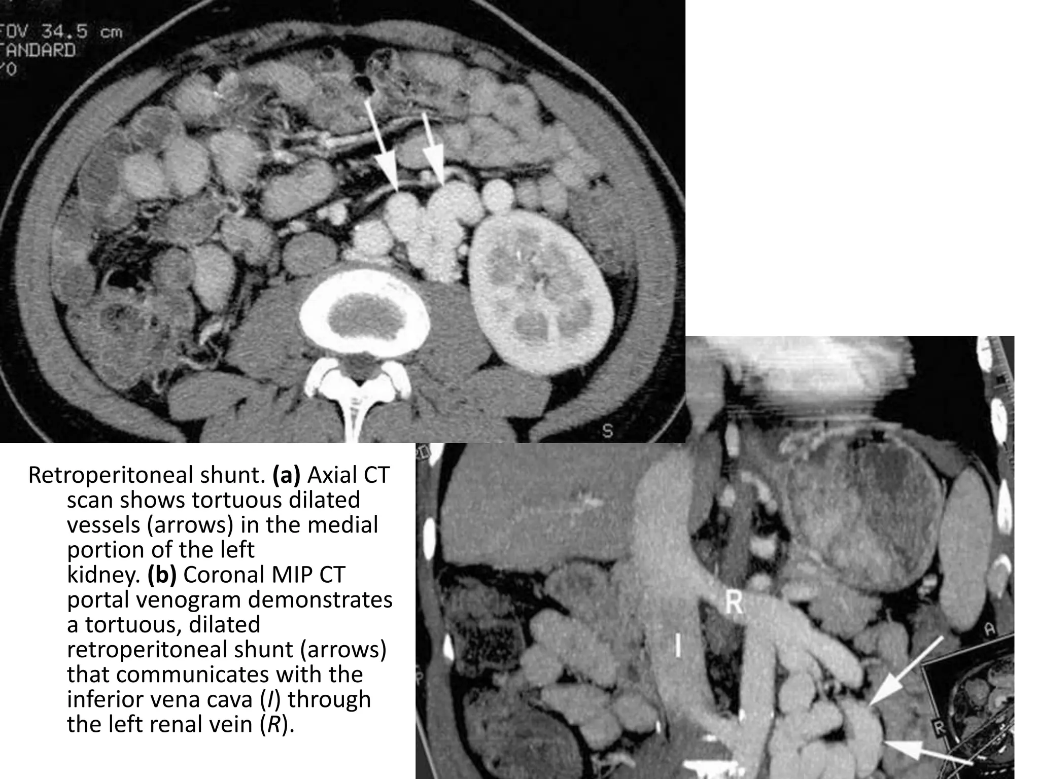 Retroperitoneal shunt. (a) Axial CT
scan shows tortuous dilated
vessels (arrows) in the medial
portion of the left
kidney. (b) Coronal MIP CT
portal venogram demonstrates
a tortuous, dilated
retroperitoneal shunt (arrows)
that communicates with the
inferior vena cava (I) through
the left renal vein (R).
 