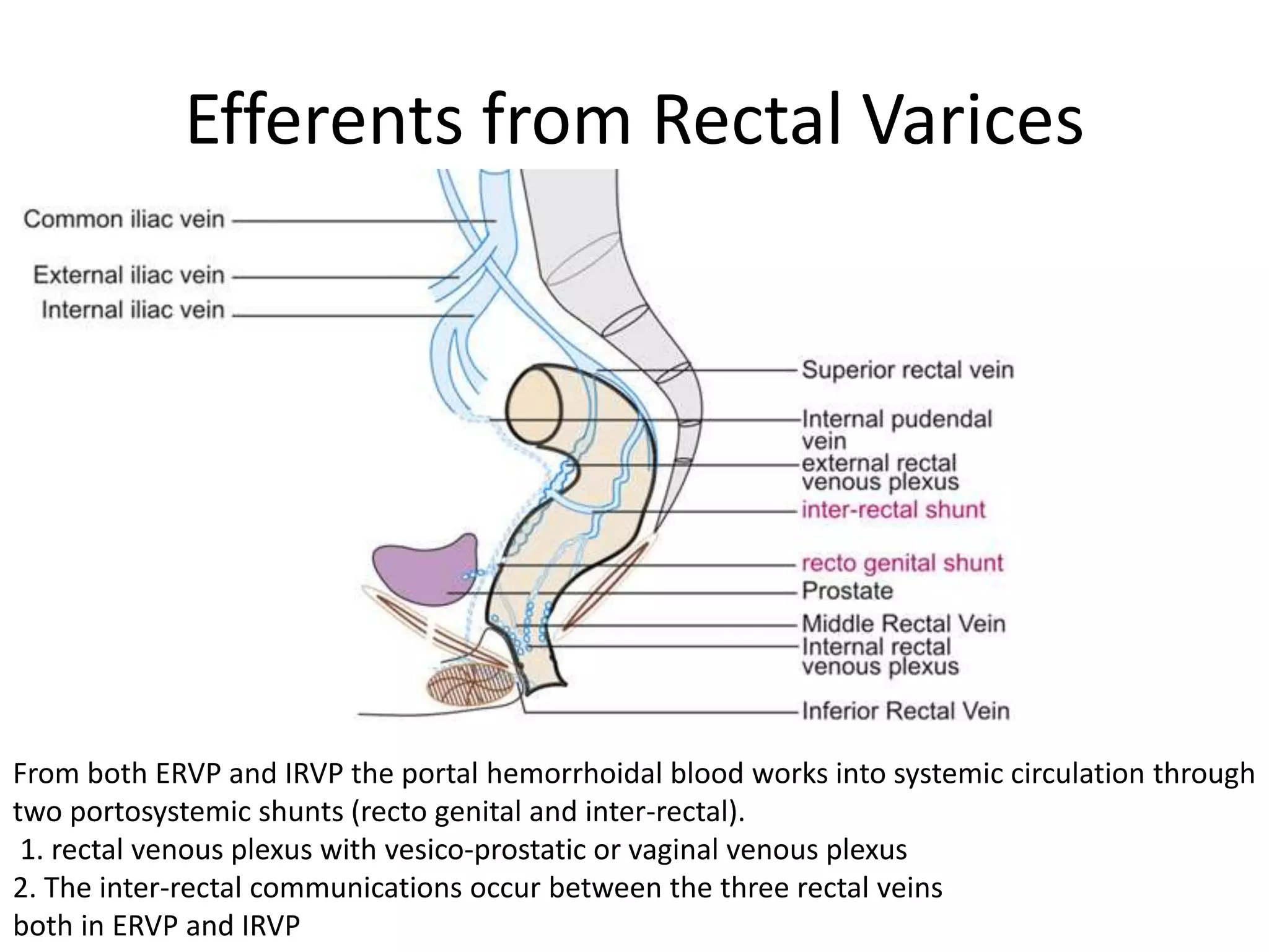 Efferents from Rectal Varices
From both ERVP and IRVP the portal hemorrhoidal blood works into systemic circulation through
two portosystemic shunts (recto genital and inter-rectal).
1. rectal venous plexus with vesico-prostatic or vaginal venous plexus
2. The inter-rectal communications occur between the three rectal veins
both in ERVP and IRVP
 