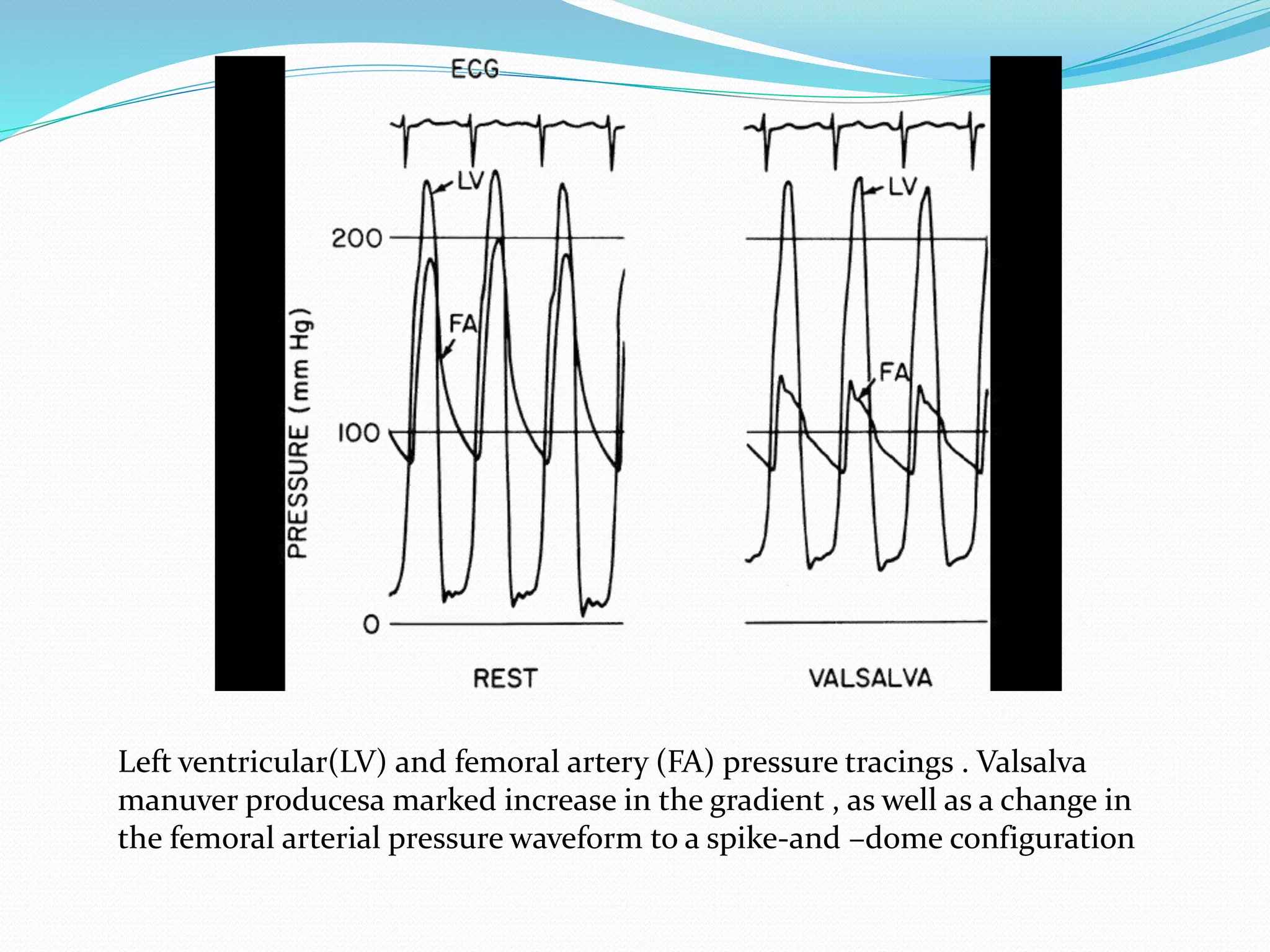 Left ventricular(LV) and femoral artery (FA) pressure tracings . Valsalva
manuver producesa marked increase in the gradient , as well as a change in
the femoral arterial pressure waveform to a spike-and –dome configuration
 