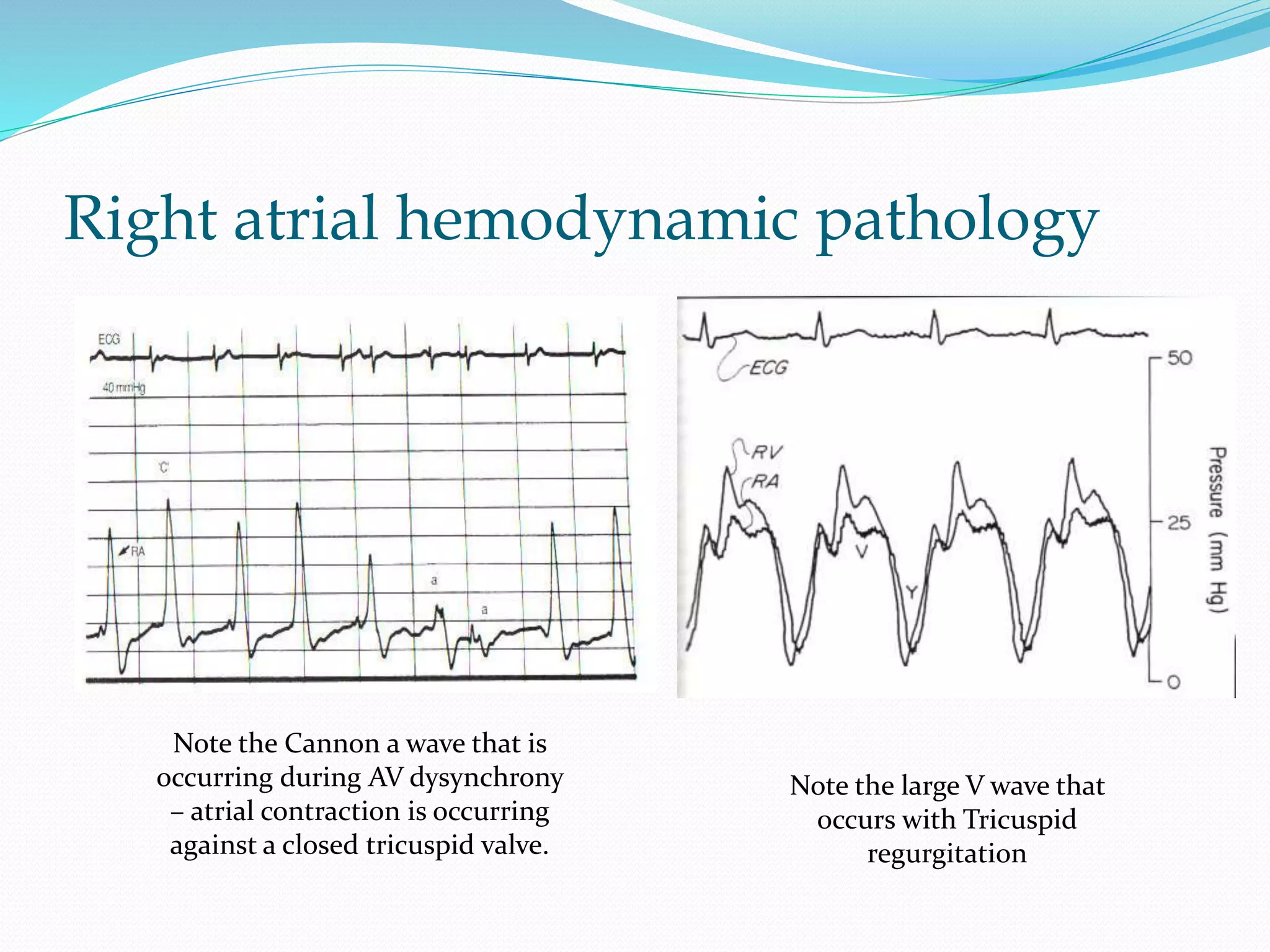 Right atrial hemodynamic pathology
Note the Cannon a wave that is
occurring during AV dysynchrony
– atrial contraction is occurring
against a closed tricuspid valve.
Note the large V wave that
occurs with Tricuspid
regurgitation
 