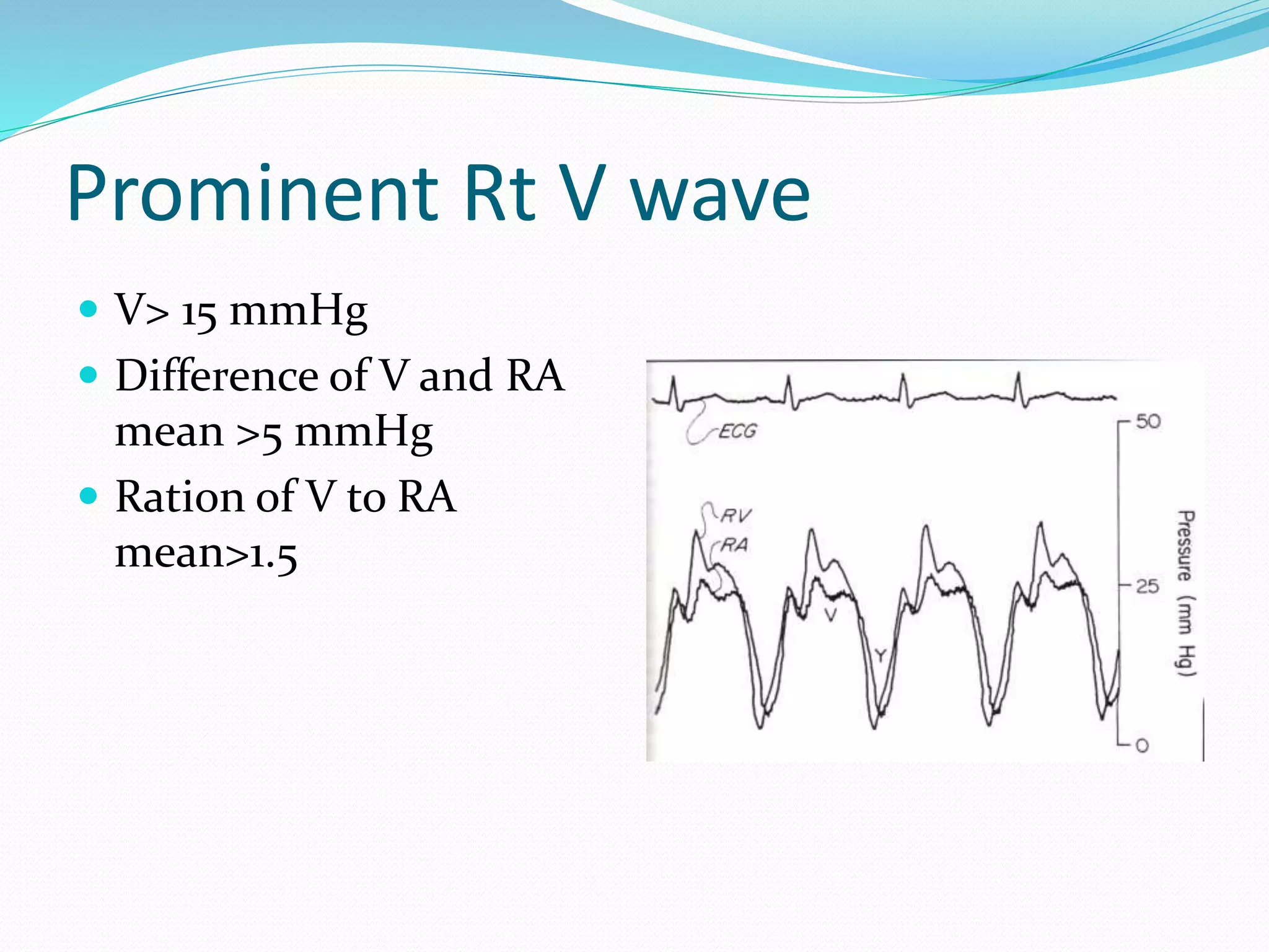 Prominent Rt V wave
 V> 15 mmHg
 Difference of V and RA
mean >5 mmHg
 Ration of V to RA
mean>1.5
 