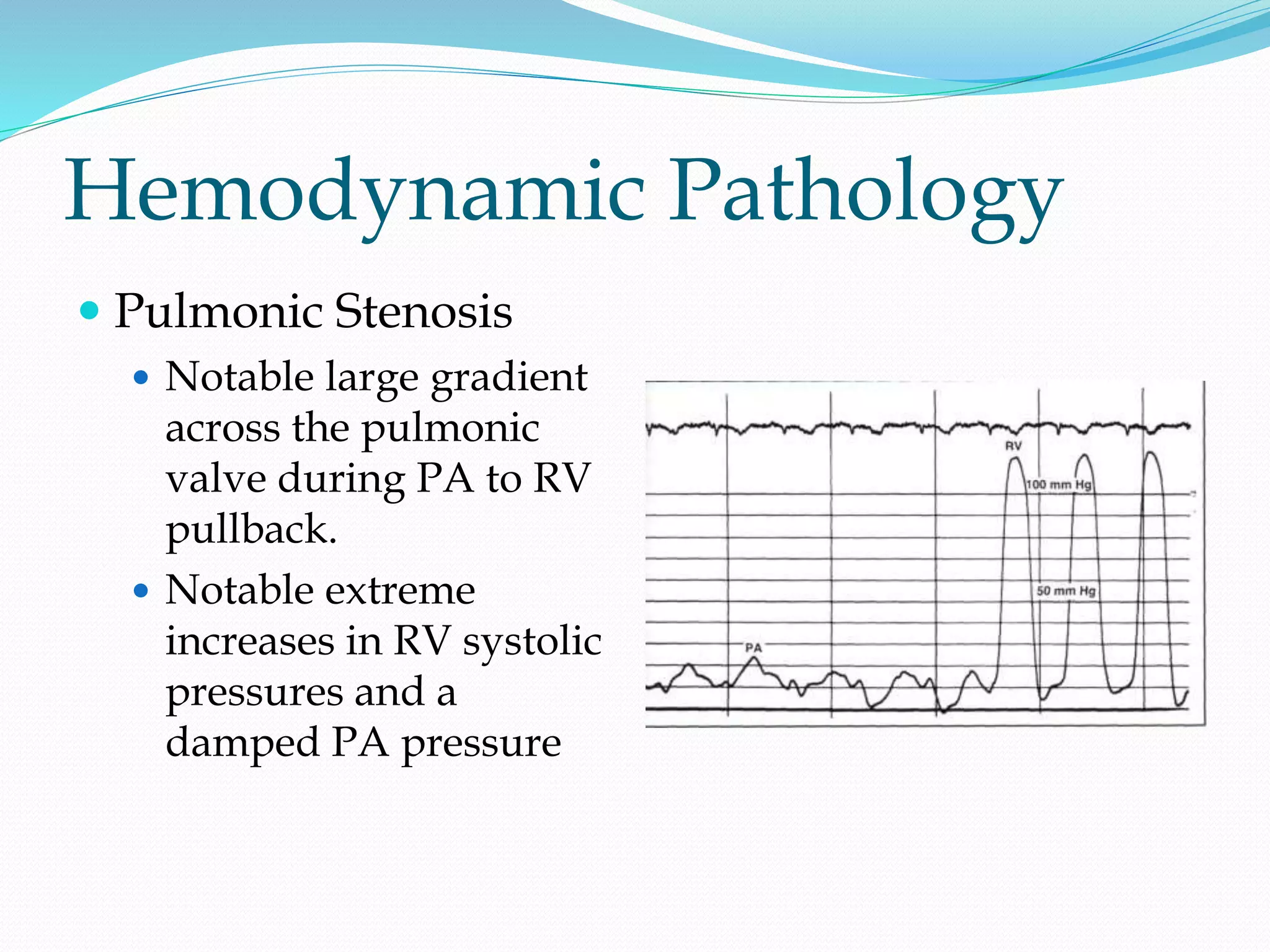 Hemodynamic Pathology
 Pulmonic Stenosis
 Notable large gradient
across the pulmonic
valve during PA to RV
pullback.
 Notable extreme
increases in RV systolic
pressures and a
damped PA pressure
 
