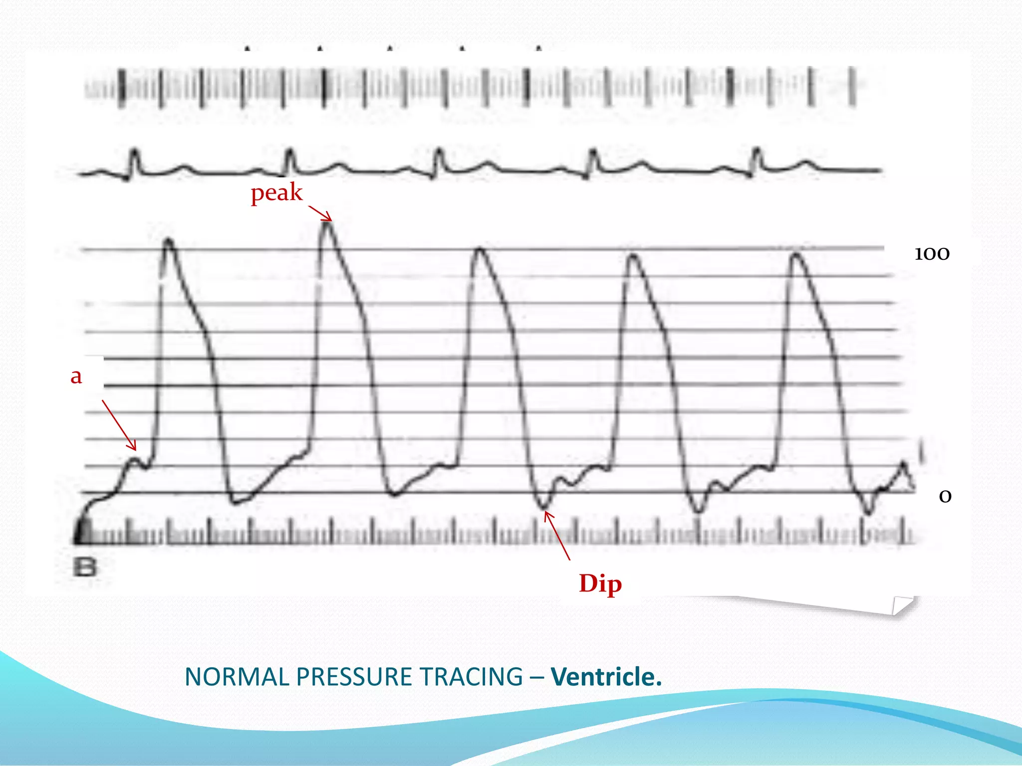 NORMAL PRESSURE TRACING – Ventricle.
peak
a
Dip
0
100
 