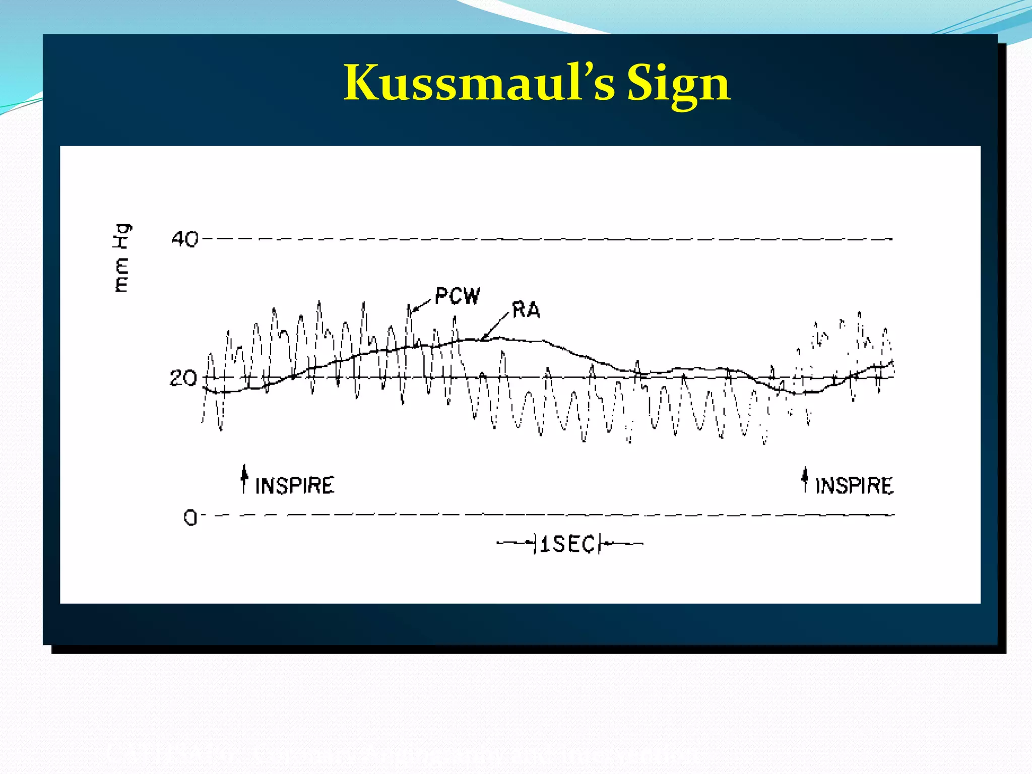 Kussmaul’s Sign
CATHSAP6: Coronary Angiography and Intervention
 