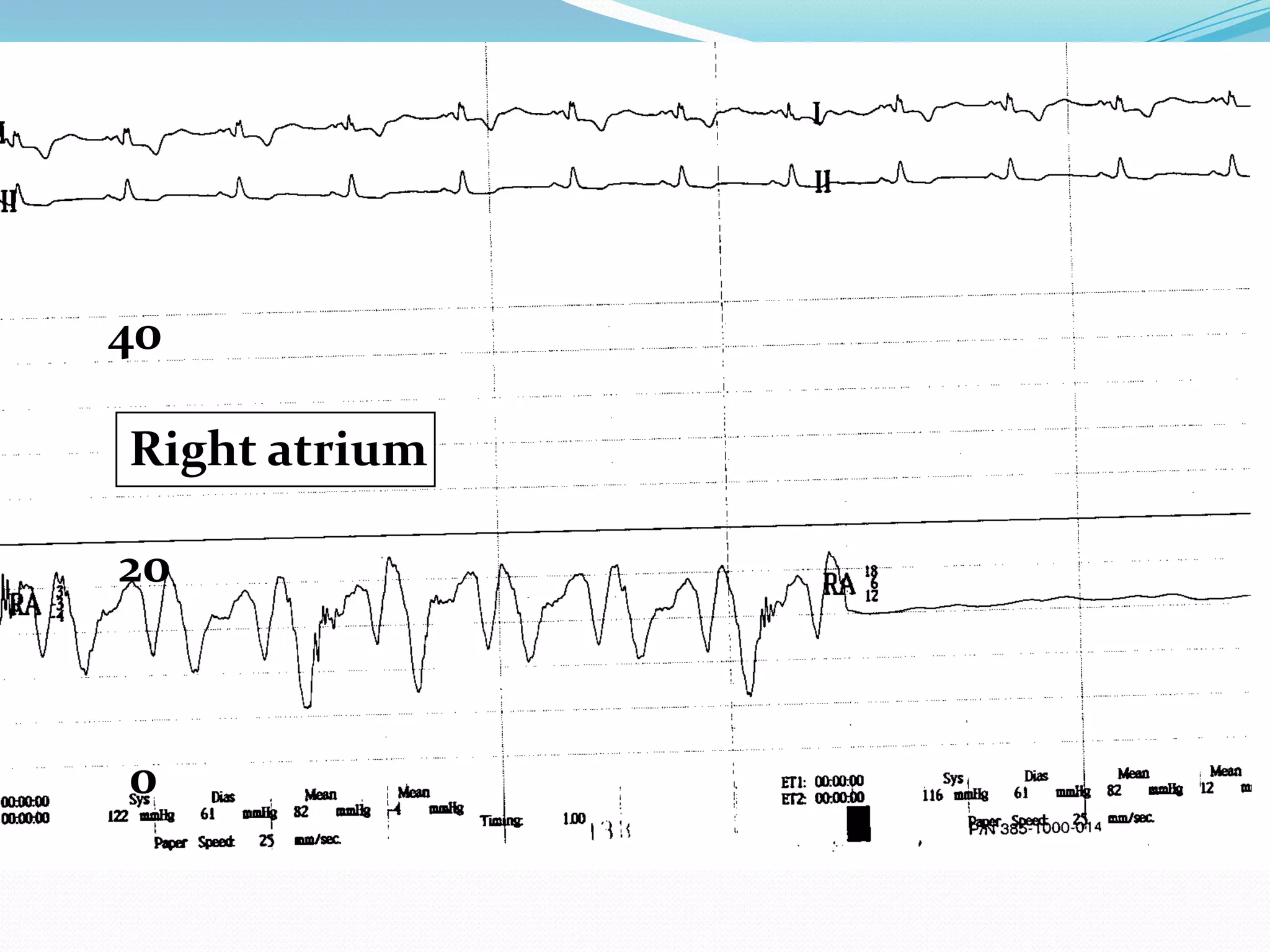 40
Right atrium

20

0

 