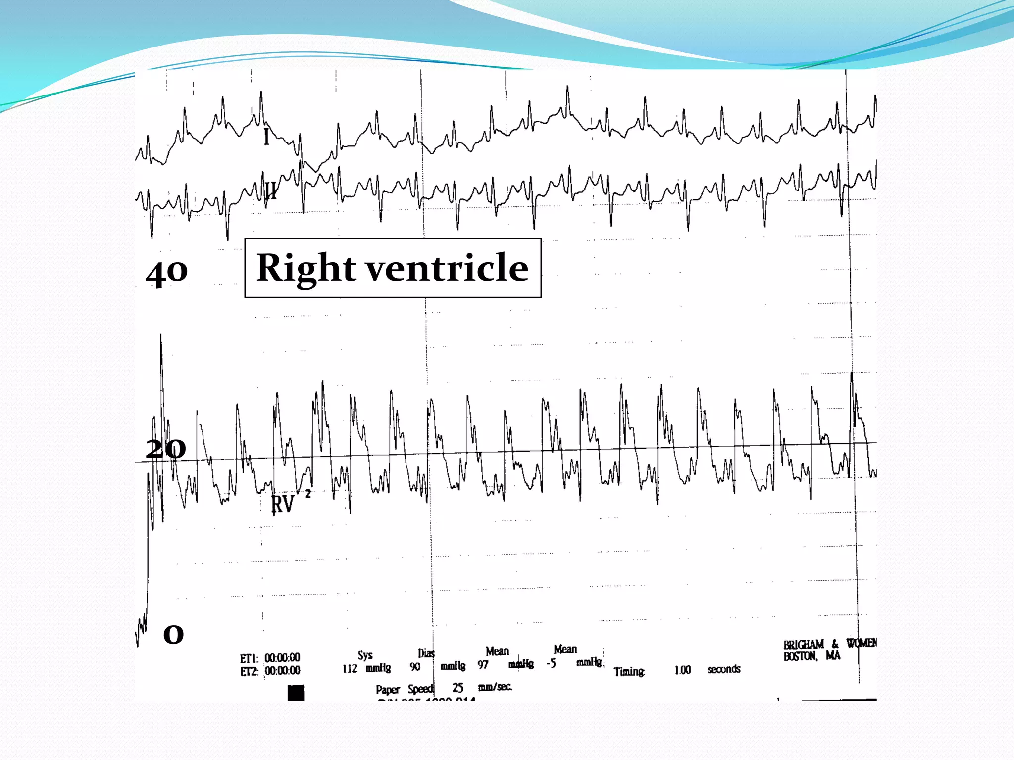 40

20

0

Right ventricle

 