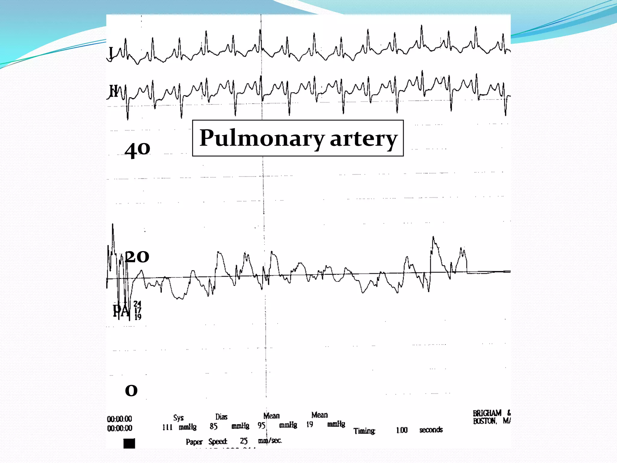 40

20

0

Pulmonary artery

 