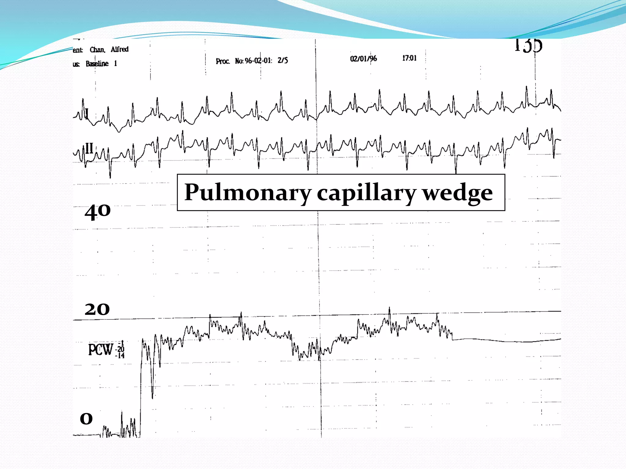 40

20

0

Pulmonary capillary wedge

 