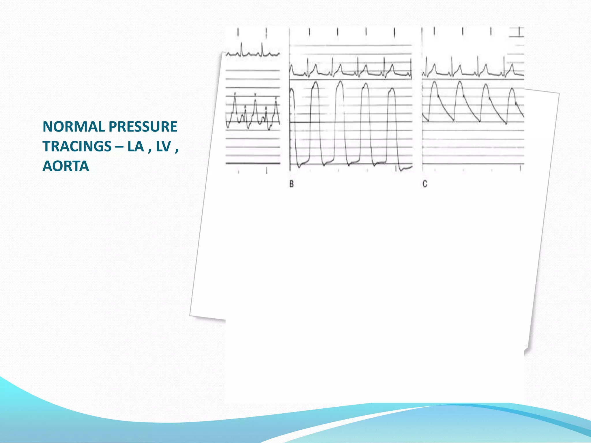 NORMAL PRESSURE
TRACINGS – LA , LV ,
AORTA

 