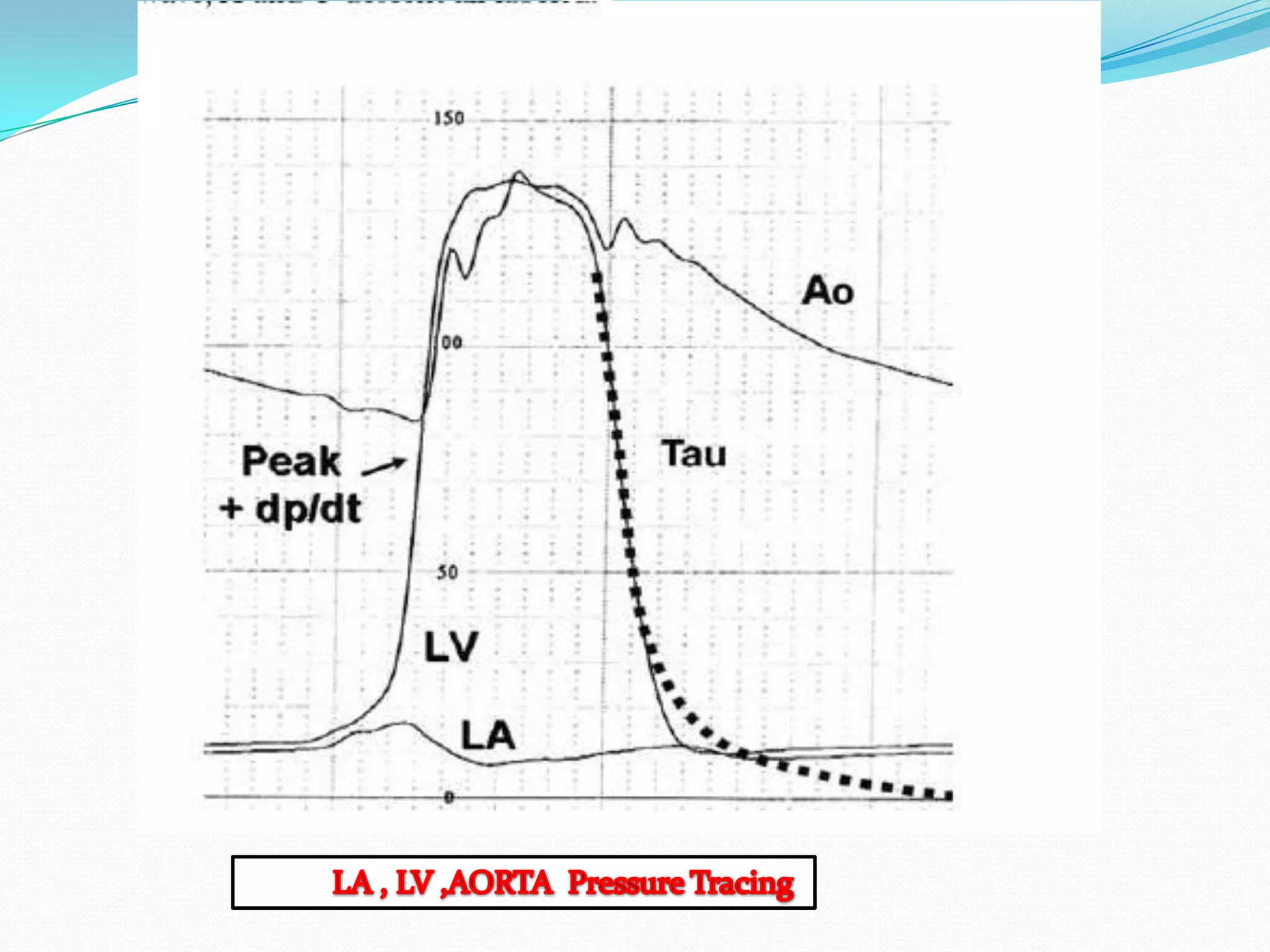 Collection of cath tracings by navin