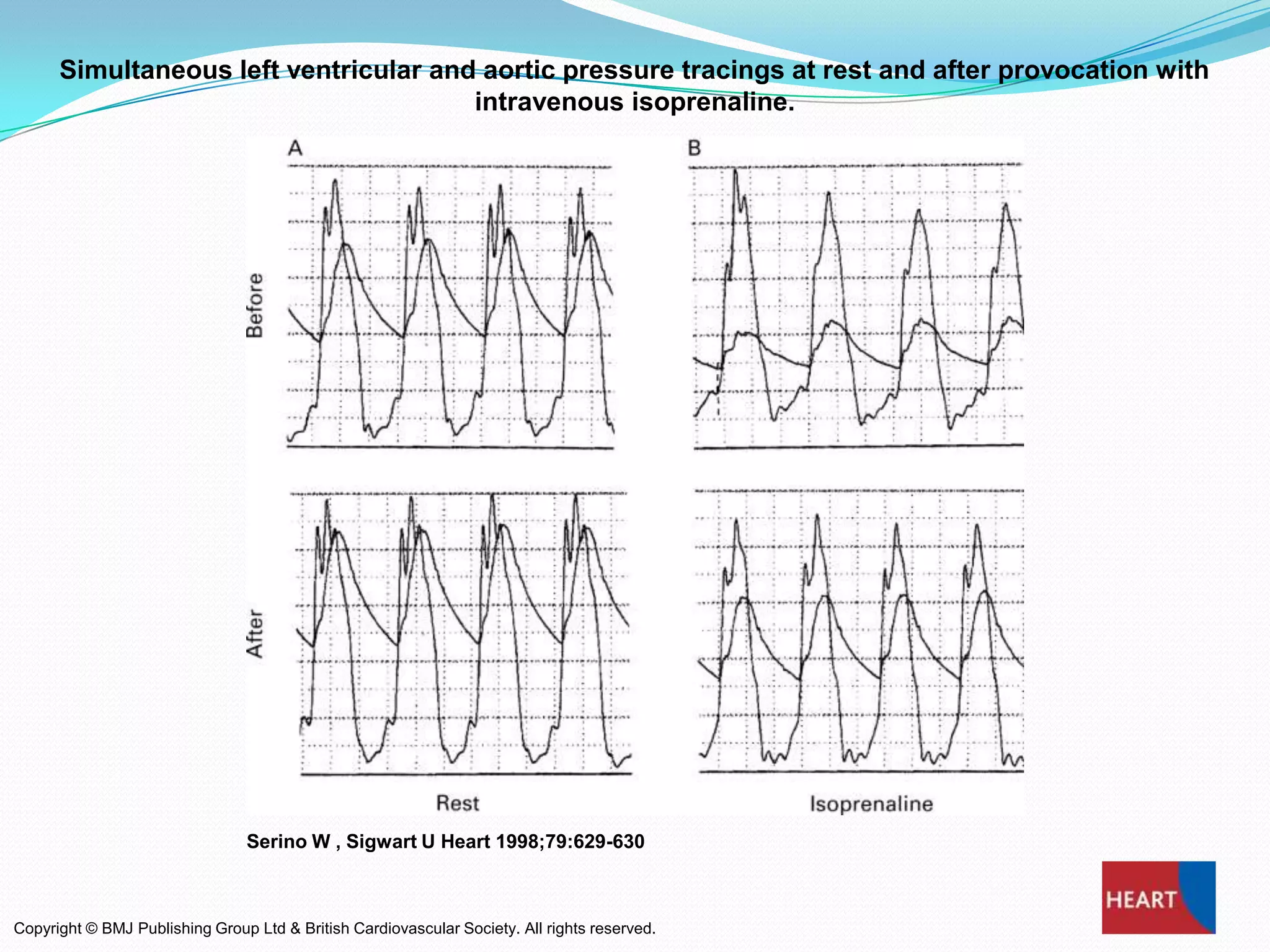 Simultaneous left ventricular and aortic pressure tracings at rest and after provocation with
intravenous isoprenaline.

Serino W , Sigwart U Heart 1998;79:629-630

Copyright © BMJ Publishing Group Ltd & British Cardiovascular Society. All rights reserved.

 