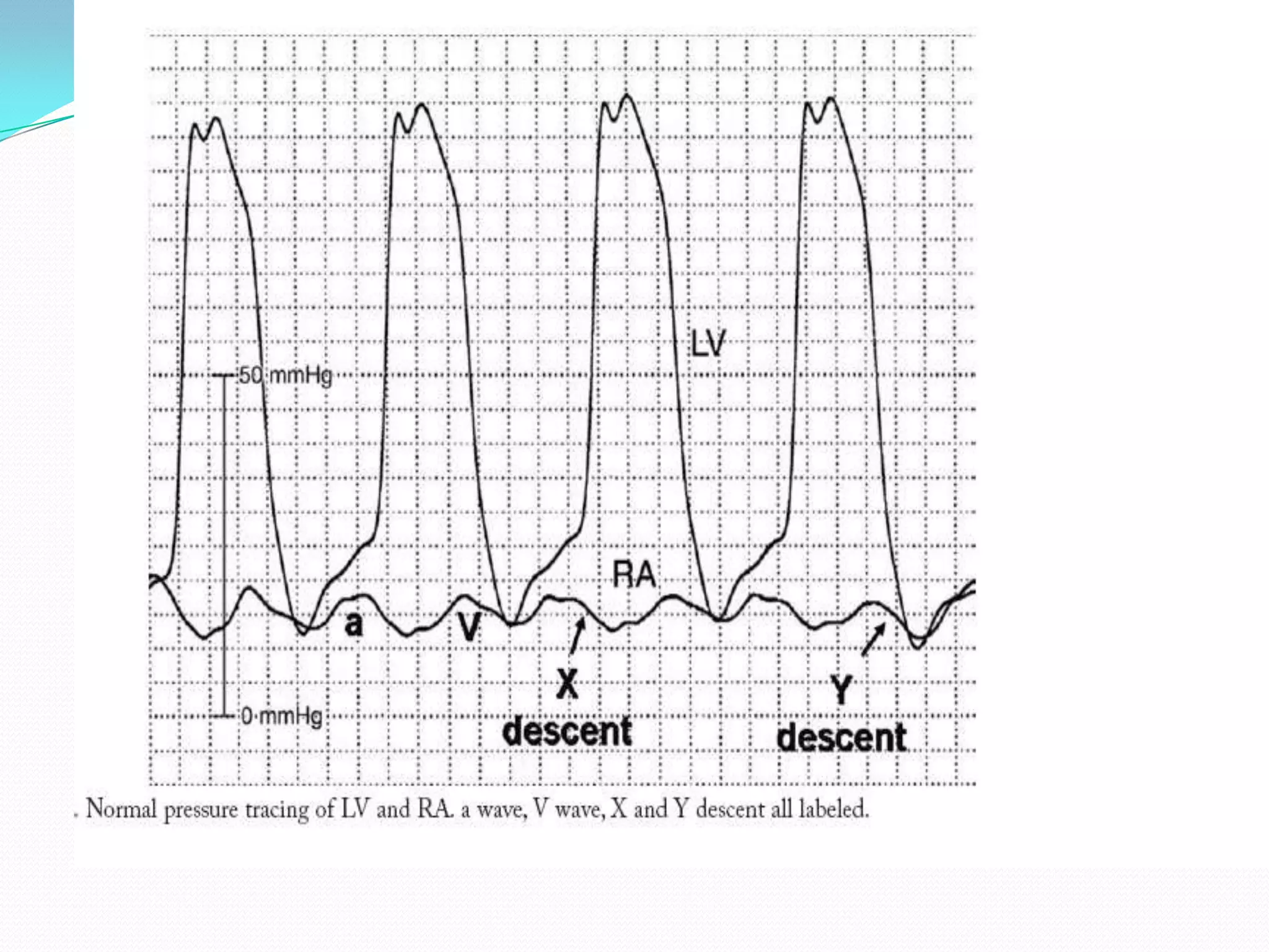 Collection of cath tracings by navin